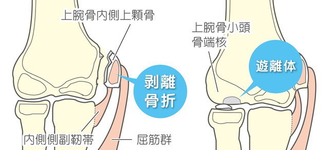 野球肘　関節ねずみ　上腕骨内側上顆骨　剥離骨折　内側側副靭帯　屈筋群　上腕骨小頭骨端核　遊離体