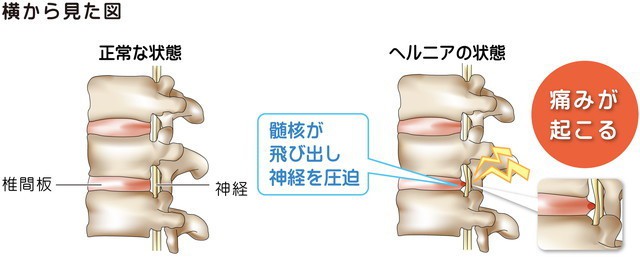 椎間板　腰椎　ヘルニア　髄核が飛び出し神経を圧迫　神経