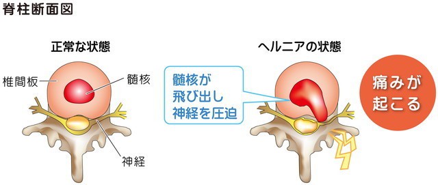 椎間板　髄核　神経　脊柱断面図　腰椎　ヘルニア　髄核が飛び出し神経を圧迫