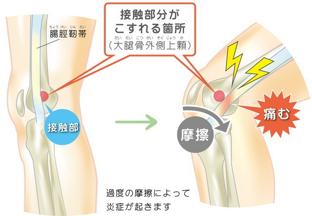 腸脛靭帯　接触部　こすれる箇所　大腿骨外側上顆　過度の摩擦によって炎症が起きます　摩擦　痛む