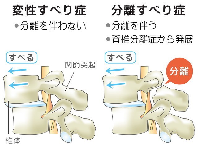 変性すべり症　分離すべり症