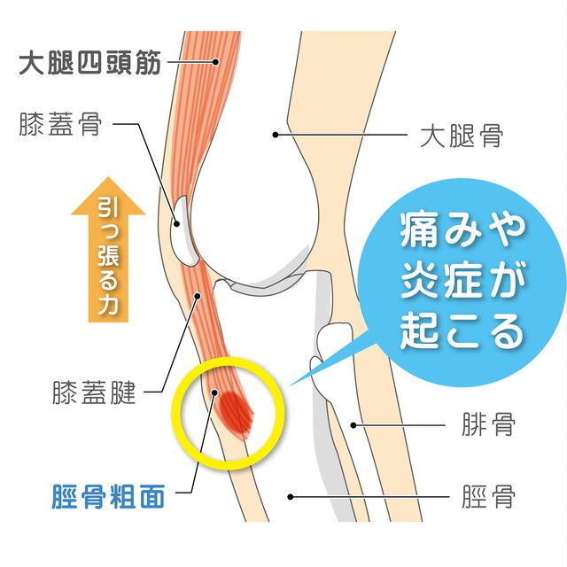 大腿四頭筋　　膝蓋骨　膝蓋腱　脛骨粗面　大腿骨　腓骨　脛骨　牽引力　炎症　オスグッド・シュラッター病