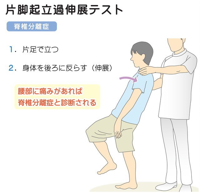 片脚起立過伸展テスト　脊椎分離症　腰椎分離症　腰部に痛みがあれば脊椎腰椎分離症と診断される　身体を後ろに反らす伸展