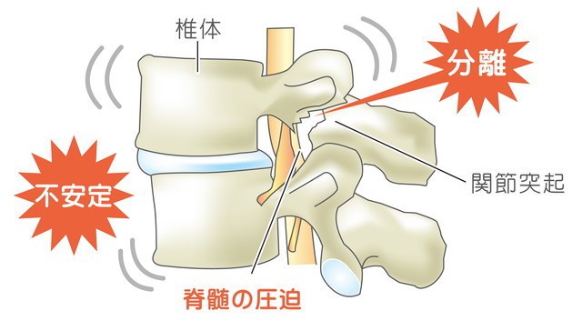 腰椎分離症　椎体　脊髄圧迫　関節突起