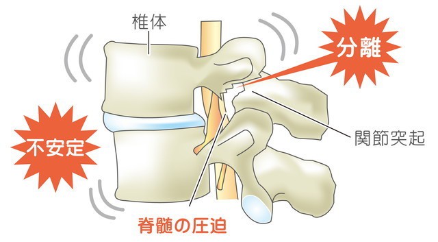 腰椎分離症