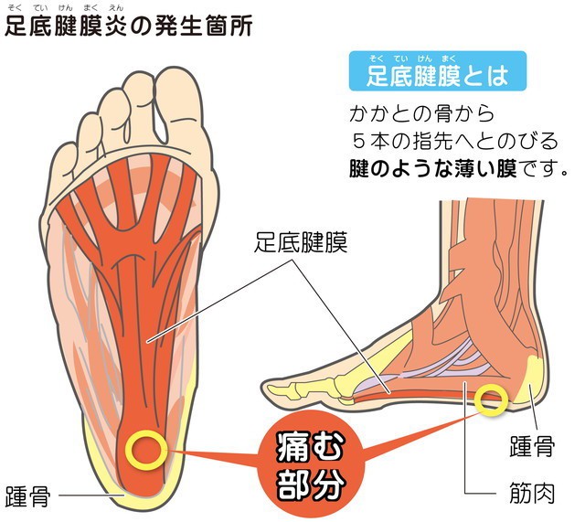 足底筋膜炎　足底筋膜とは腱のような薄い膜　足底腱膜　踵骨　筋肉