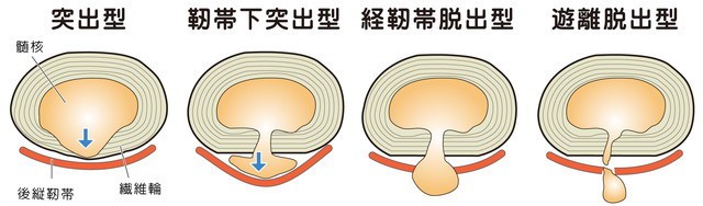 腰椎椎間板ヘルニア　突出型　靭帯下突出型　経靭帯脱出型　遊離脱出型　髄核　後縦靭帯　線維輪