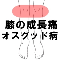 膝の成長痛 オスグッド病 バスケットボール