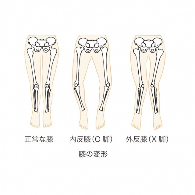 正常な膝　内反膝　O脚　外反膝　膝の変形