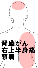 腎臓がん　右上半身痛　頭痛