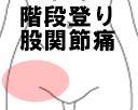 階段上りおり 股関節痛 腰椎分離症
