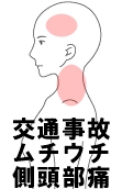 交通事故　ムチウチ　側頭部痛