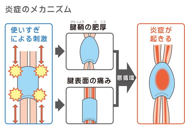 炎症のメカニズム　腱鞘炎の肥厚　腱表面の痛み　悪循環　