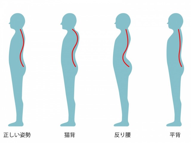 猫背　反り腰　平背