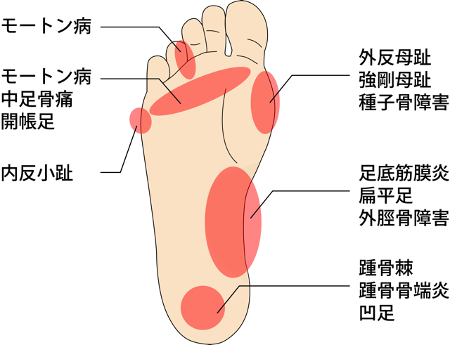 モートン病　外反母趾　足底筋膜炎　偏平足　