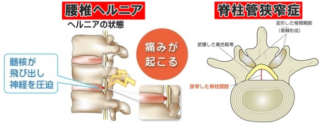 坐骨神経痛　腰椎ヘルニア　脊柱管狭窄症