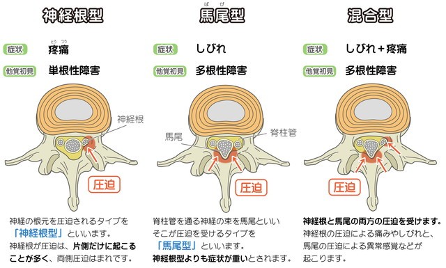 脊柱管狭窄症　神経根型　馬尾型　混合型