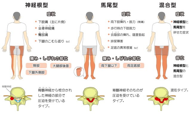 脊柱管狭窄症　神経根型　馬尾型　混合型