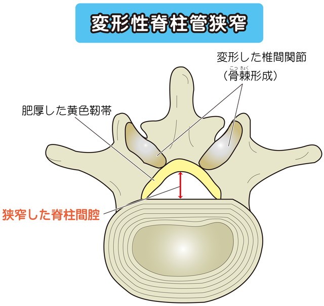 脊柱管狭窄　黄色靭帯