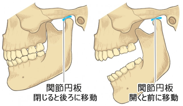 顎関節症　関節円板