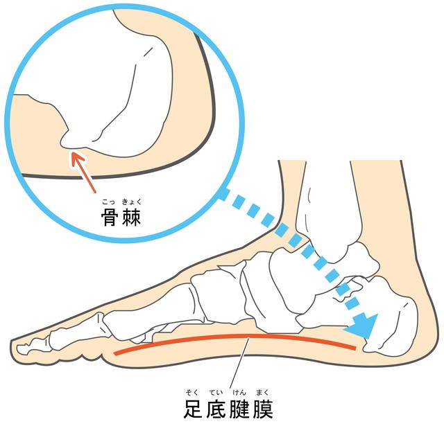 足底筋膜　骨棘