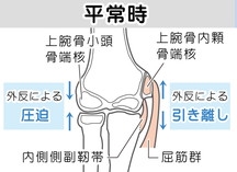 平常時　内側型　外側型　上腕骨小頭骨端核　上腕骨内顆骨端核　外反による圧迫　外反による引き離し　内側側副靭帯　屈筋群　剥離内側側副靭帯　屈筋群　上腕骨小頭骨端核　壊死　遊離体　関節ねずみ　高槻スポーツ整体　ぎの整体院