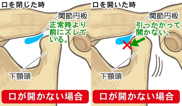 関節円板　下顎頭　下顎頭　関節円板　口が開かない場合