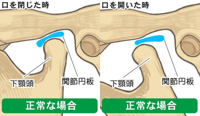 顎関節　関節円板　下顎頭