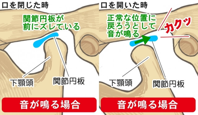 関節円板　下顎頭　音が鳴る　下顎頭　関節円板　音が鳴る