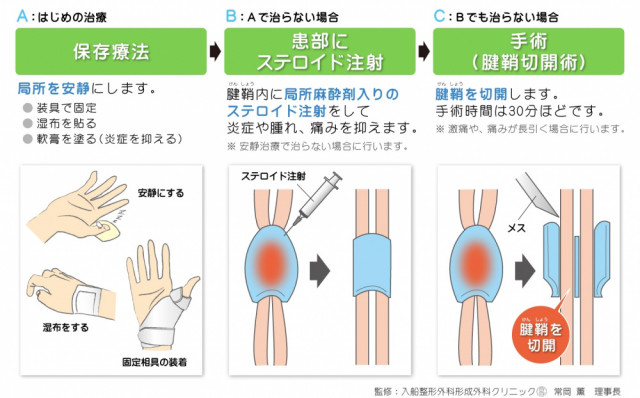 ばね指　腱鞘炎　