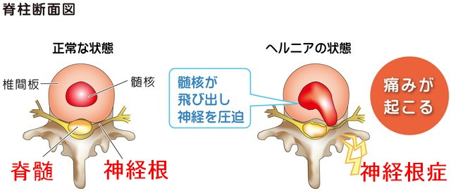 ヘルニア　頚椎症性脊髄症　頚椎症性神経根症