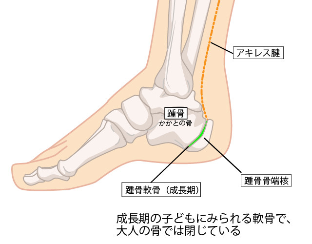 成長痛　成長期　子供　踵骨骨端核