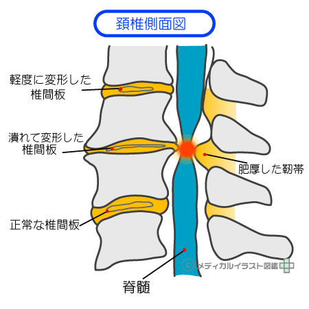 頚椎