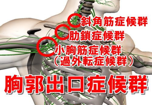 胸郭出口症候群　斜角筋症候群　肋鎖症候群　小胸筋症候群