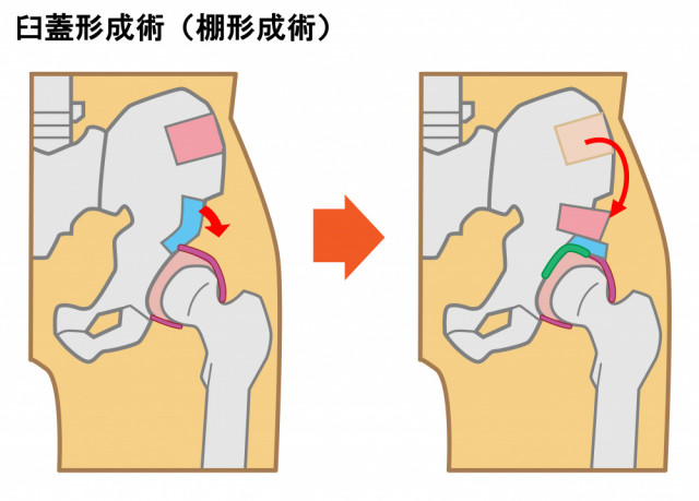 臼蓋形成不全　手術