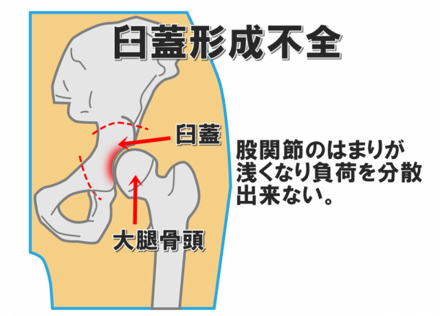 臼蓋形成不全　股関節