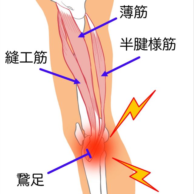 鵞足炎　薄筋　縫工筋　半腱様筋