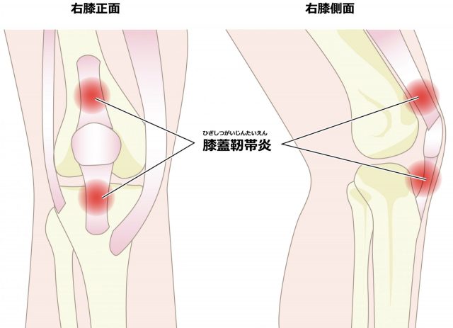 膝蓋靱帯炎　ジャンパー膝