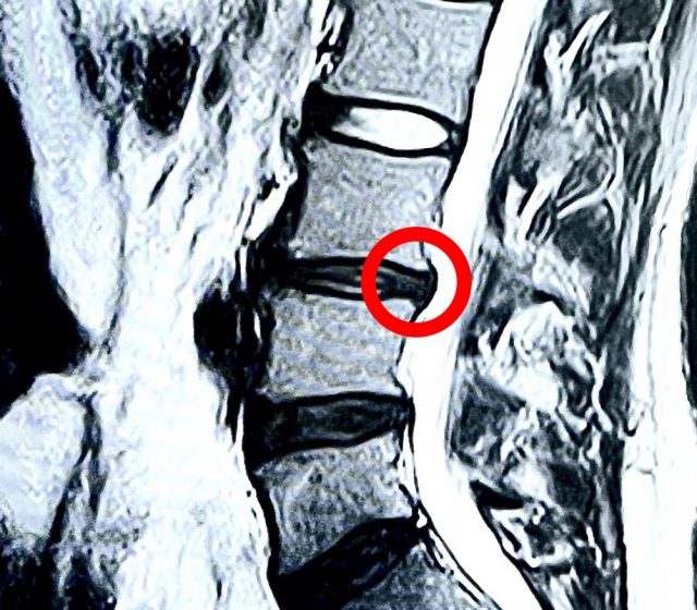 腰椎椎間板ヘルニア　MRI