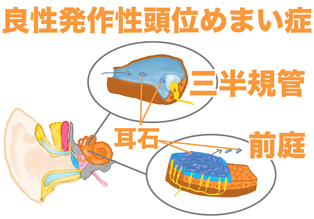 良性発作性頭位めまい症 耳石 三半規管 前庭
